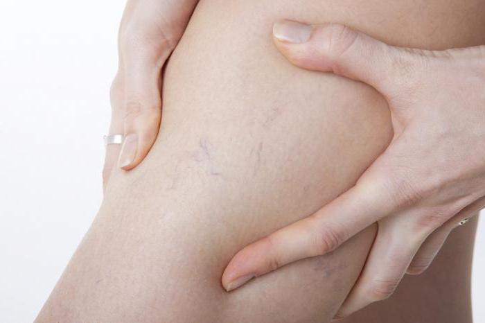 varices