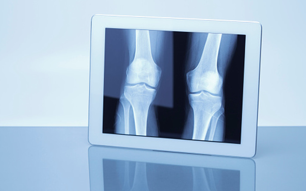 consejos osteoporosis