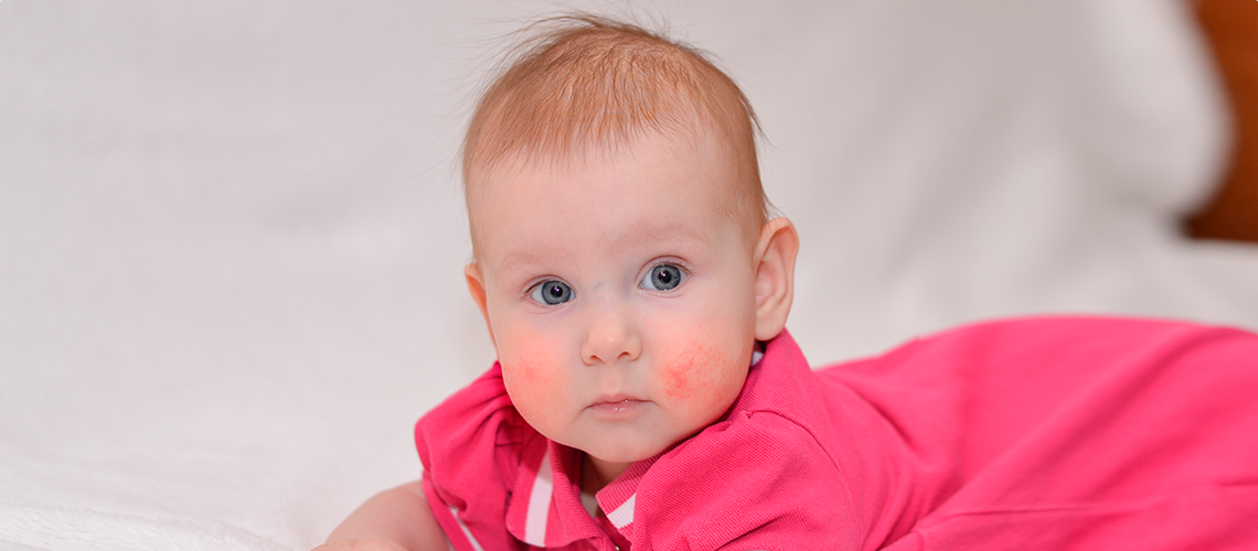 dermatitis atópica