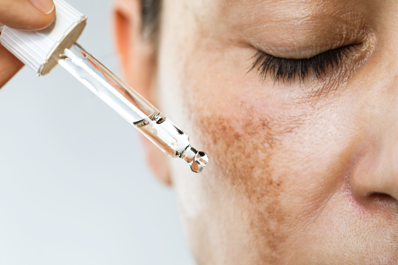 Melasma gestacional