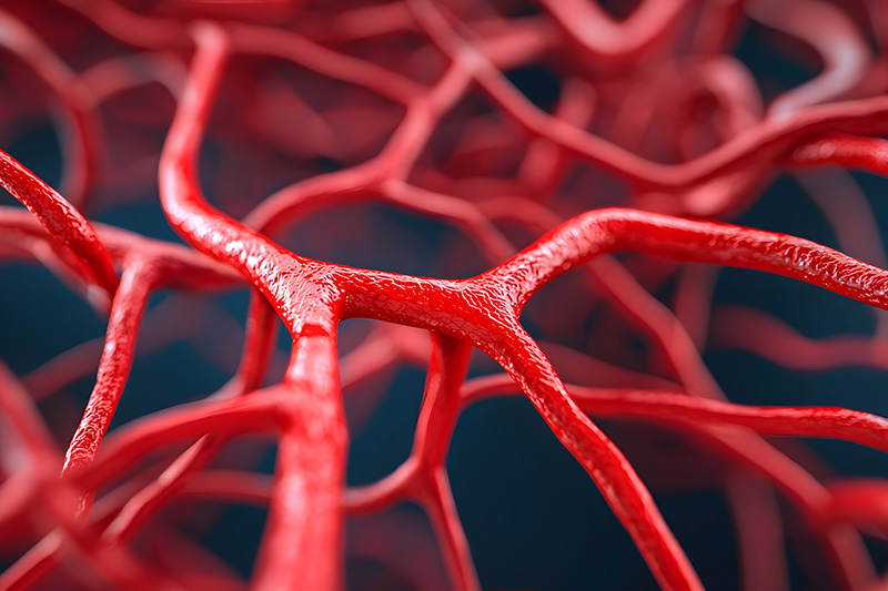 aterosclerosis
