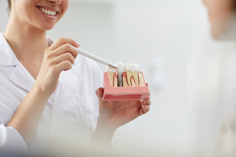 Diente o muela nuevos: Consejos para cuidar el implante dental