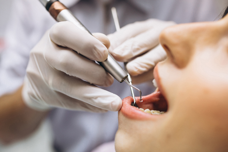 Qué es una endodoncia y para qué sirve