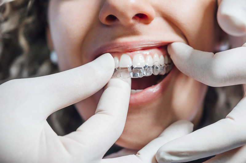 doctor putting clear dental aligner to the patient woman