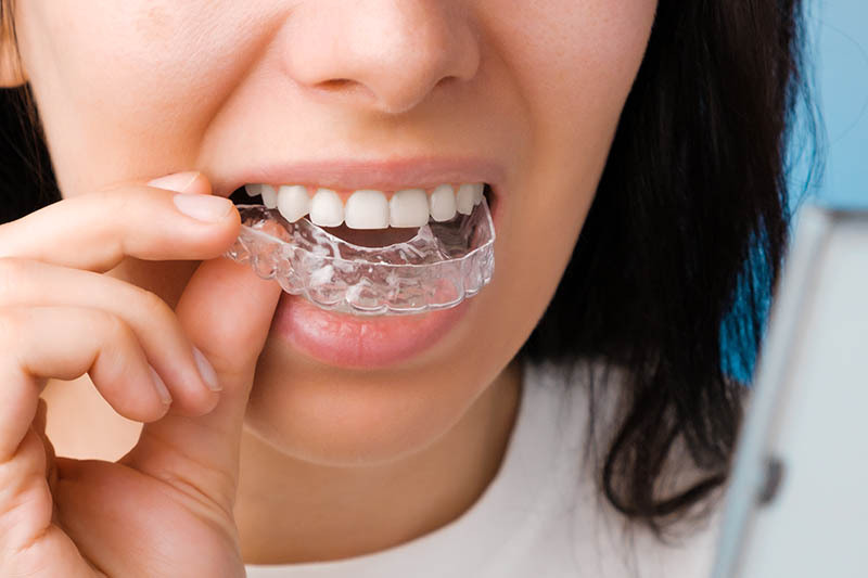 smiling woman with perfect and healthy teeth using removable braces
