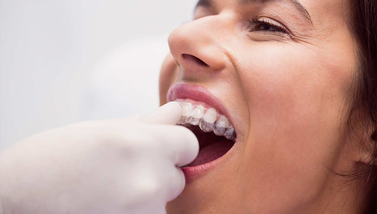 Ferula de descarga en Odontologia