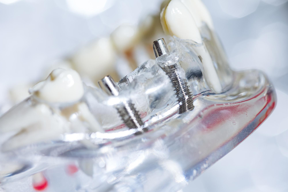 tornillo implante dental