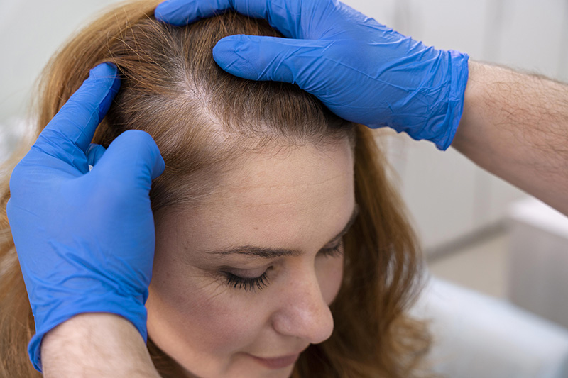 mujer recibiendo tratamiento perdida cabello clinica