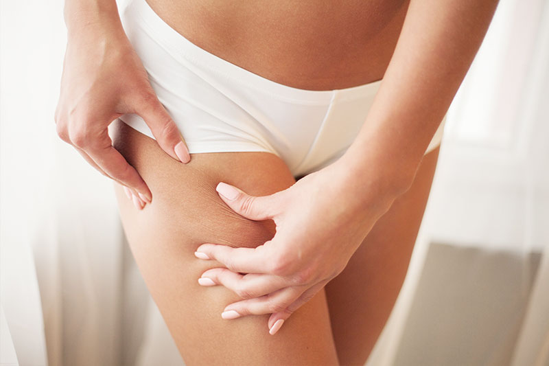 Carboxiterapia para la celulitis