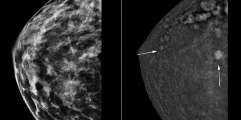 La Unidad de Mama de Ribera Salud pone en marcha la mamografía 3D con contraste que permite la detección de tumores de apenas 4 milímetros